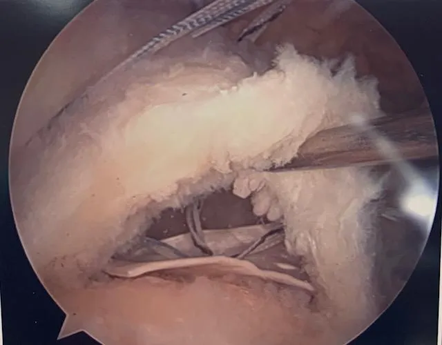 Breakthrough IN Rotator Cuff Repair Surgery Rotium Patch