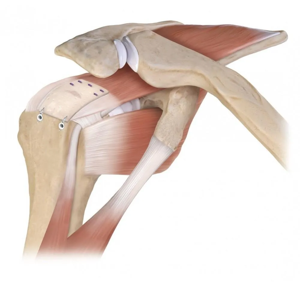 Rotator Cuff Repair Breakthrough With Cuffmend