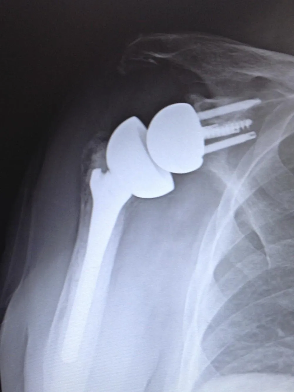 Signs YOU MAY Need A Reverse Total Shoulder Replacement IN Ohio